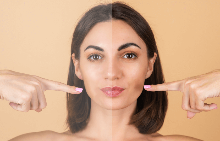 How to Apply Melas Face Cream for Dark Spots and what are its Advantages?